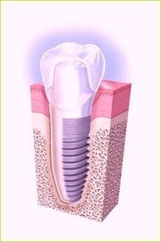 Implant dentaire