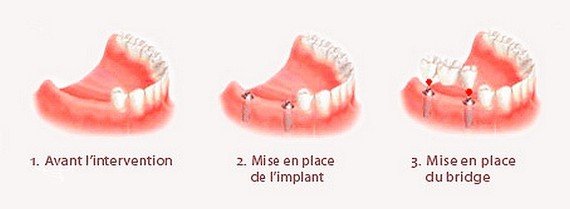 Implants dentaires