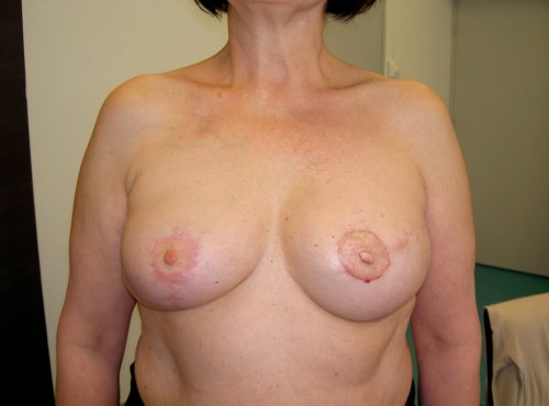 Intervention de reconstruction mammaire - après